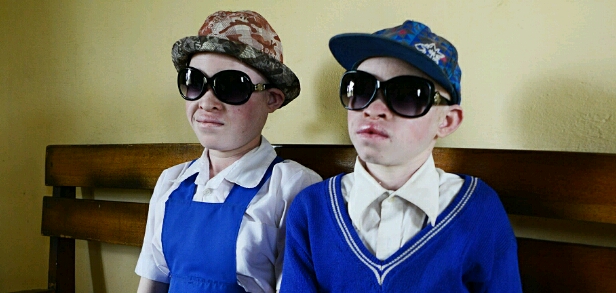 people with albinism sunglasses